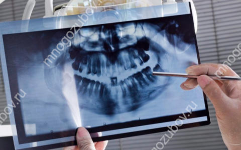 МРТ височно-нижнечелюстного сустава – что это и зачем проводится