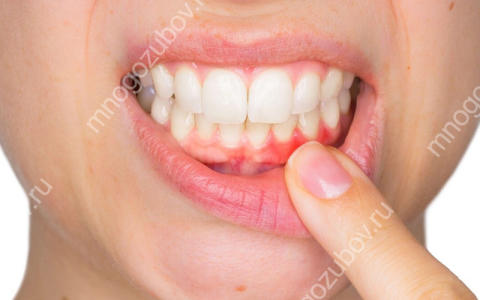 Локализованный пародонтит