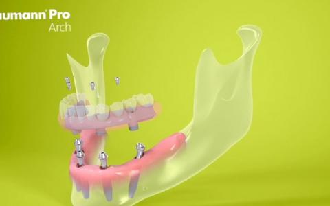 Имплантация Pro Arch