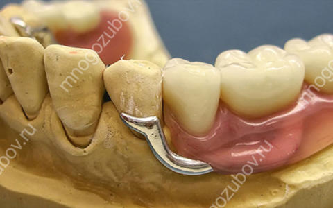 Бюгельные зубные протезы на кламмерах