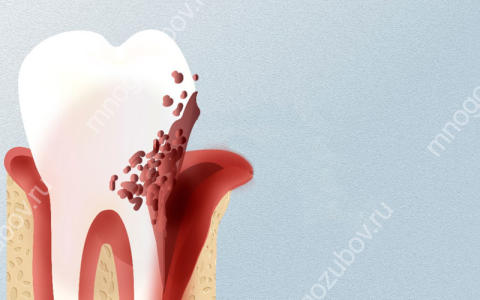 Острый пародонтит