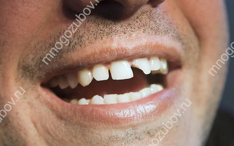 Что делать, если откололся зуб