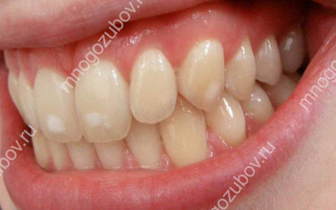 Белые пятна на зубах