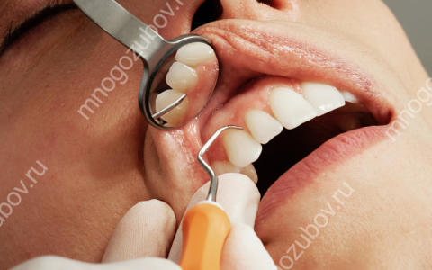 Генерализованный пародонтит