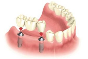 Где сделать имплантацию зубов — общие принципы выбора клиники, обзор цен