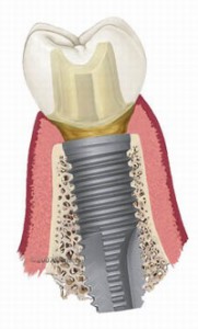 Срок службы зубных имплантов, гарантия и советы по уходу
