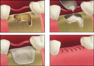 Костная пластика или остеопластика в стоматологии, обзор цен