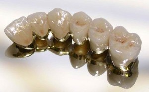 Металлокерамика для зубов, обзор цен