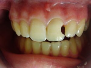 Передний зуб кариес фото до и после лечения thumbnail