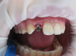 Как вылечить передние зубы от кариеса thumbnail