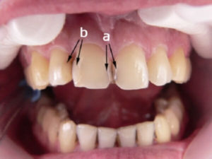 Лечение передних верхних зубов когда требуется thumbnail
