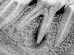 Фото: Рентгет-снимок зуба