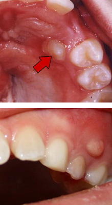 Хронический гранулирующий периодонтит зуба лечение thumbnail