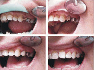 Фото: Коронки на жевательные зубы