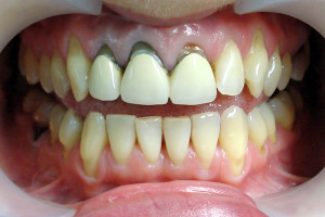 Протезирование передних верхних зубов — красивая и уверенная улыбка