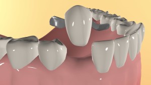 Мостовидный адгезивный протез: протезирование без обточки зубов, обзор цен