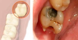 Кариес зуба мудрости  — сложное стоматологическое заболевание