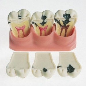Распространенность и интенсивность кариеса зубов