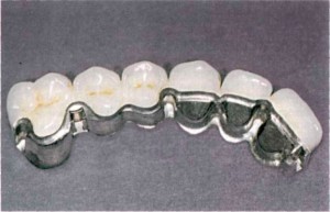Мостовидный протез из металлокерамики — эффективное восстановление зубного ряда, обзор цен