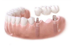 Мостовидный протез на имплантах — надежность фиксации и защита зубов