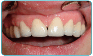 Несъемный зубной протез на имплантах — отличная альтернатива натуральным зубам