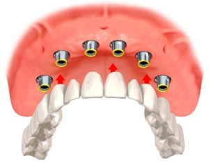 Съемные протезы на имплантах — надежная фиксация зубного ряда, обзор цен