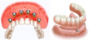 Условно-съемное протезирование на имплантатах — комфортные зубные конструкции