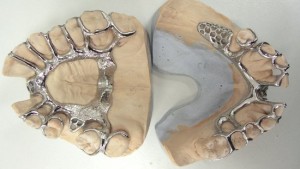 Шинирующий бюгельный протез — отличное восстановление потерянного зуба