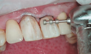 Препарирование зубов — важный процесс при восстановлении целостности зубного ряда