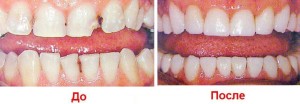 Наращивание зубов — восстановление естественного зубного ряда
