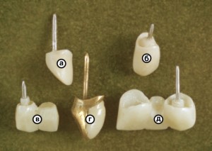 Фото: Виды зубных конструкций