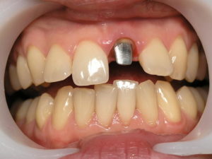 Перелом зуба лечение видео thumbnail