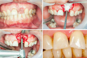Как вылечить сломанный зуб thumbnail
