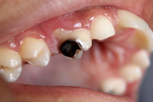 Какие последствие могут при болезни зуба thumbnail