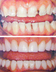 Реставрация зубов — эстетическое восстановление зубного ряда