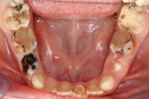 Болят зубы кариес разрушаются thumbnail