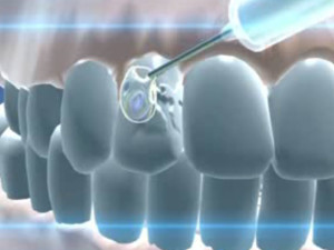 Средства для лечения кариеса зуба thumbnail