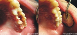 Лечение кариеса — как лечат заболевание в стоматологии?