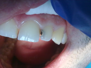Стадии кариеса — как развивается зубной недуг?
