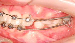 Частичная брекет-система — современное исправление зубных дефектов