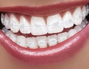 Белые брекеты — незаметные зубные конструкции