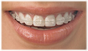 Сапфировые брекеты — эталон среди выравнивания зубного ряда