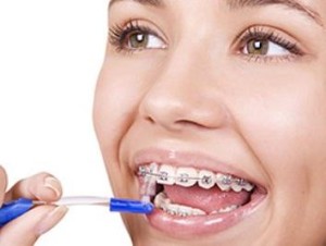 Как чистить зубы с брекетами?