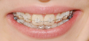 Брекеты In Ovation — удобные конструкции для лечения зубов
