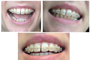Зубы после брекетов разъехались — что делать?