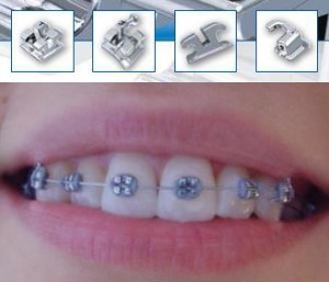 Мини-брекеты — эстетическое лечение зубов