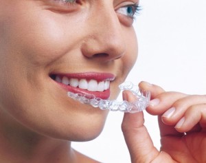 Силиконовые брекеты — мягкое лечение зубов