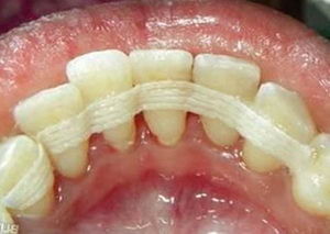 Шинирование зубов после брекетов — закрепление полученного результата