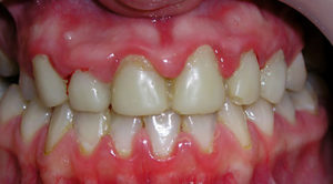 Противопоказания для имплантации зубов сахарный диабет thumbnail