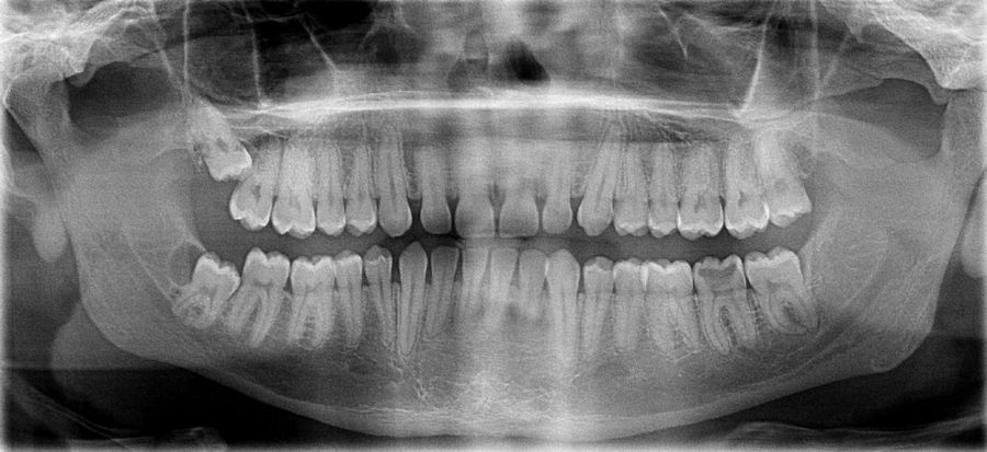 диагностика роста зубов